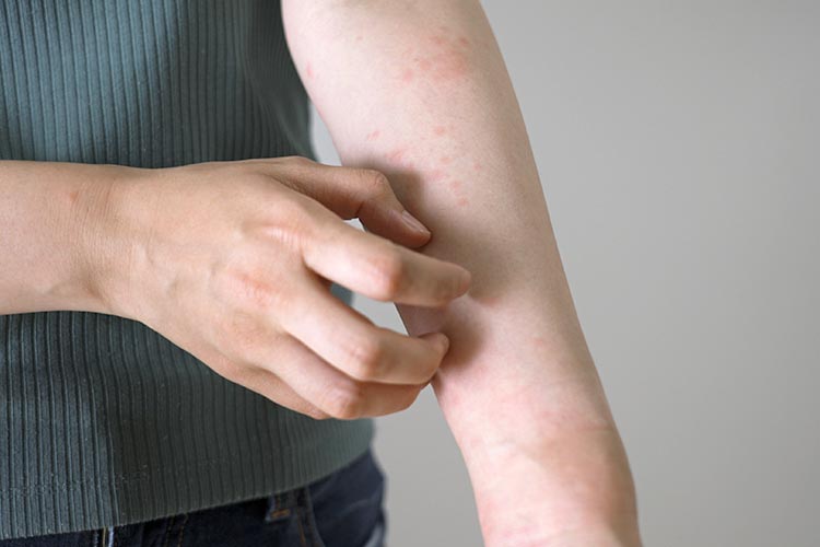 アトピー性皮膚炎のイメージ画像