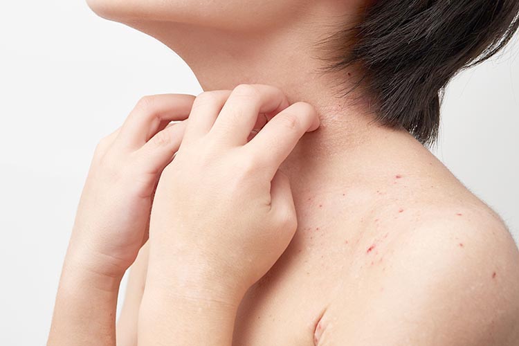 乾癬のイメージ画像