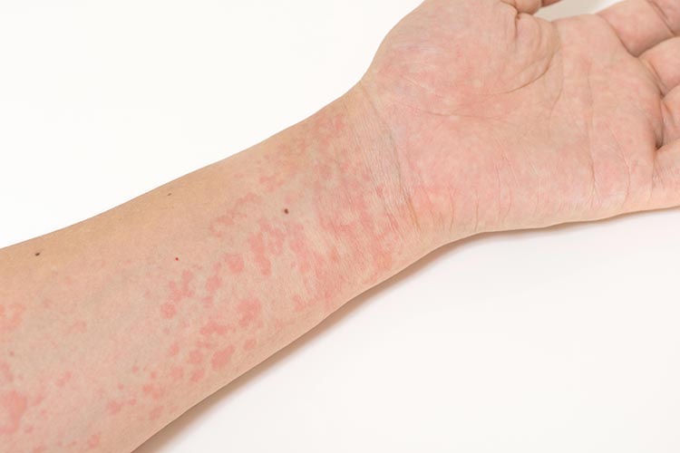 蕁麻疹のイメージ画像