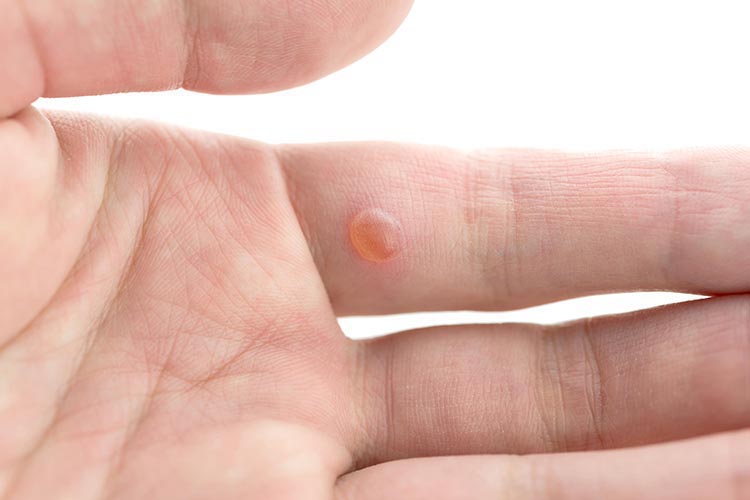 イボのイメージ画像